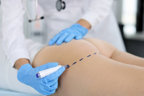 Beginner’s Guide to Brazilian Butt Lift Surgery