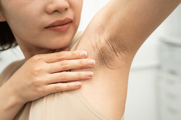 What Ingredients in Peels Cause Armpit Darkening?