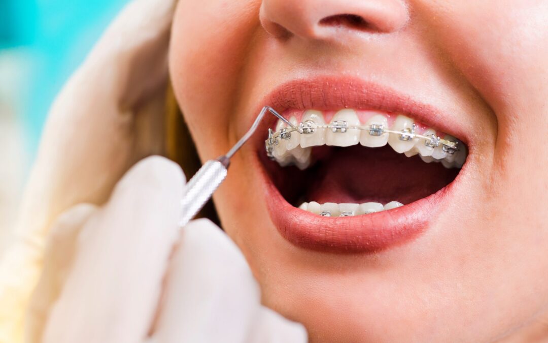 How Long Do You Need to Wear Dental Braces? Understanding the Timeline