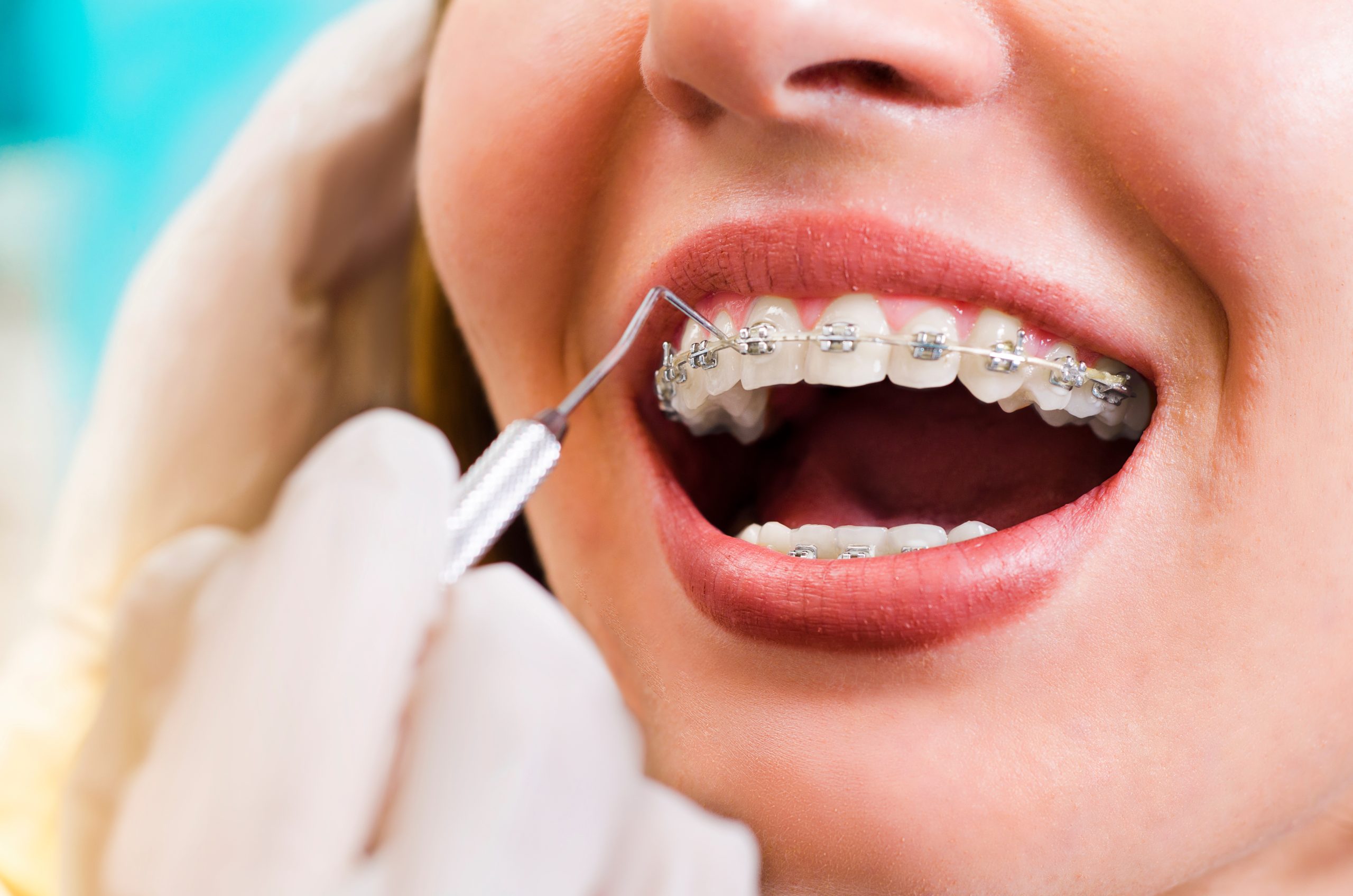 Can Adults Benefit from Dental Braces Absolutely! Here’s Why