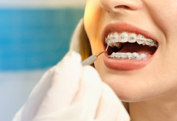 Can Braces Fix Jaw Alignment Issues? Here’s What You Should Know