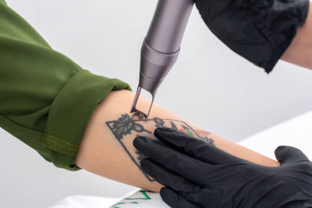 Can Laser Tattoo Removal Remove Tattoos Completely