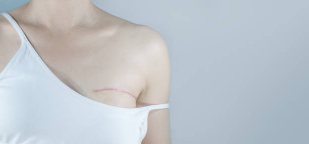 Can Surgical Scar Revision Fix Stretch Marks