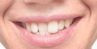 Night Guards and Crowded Teeth: What You Need to Know