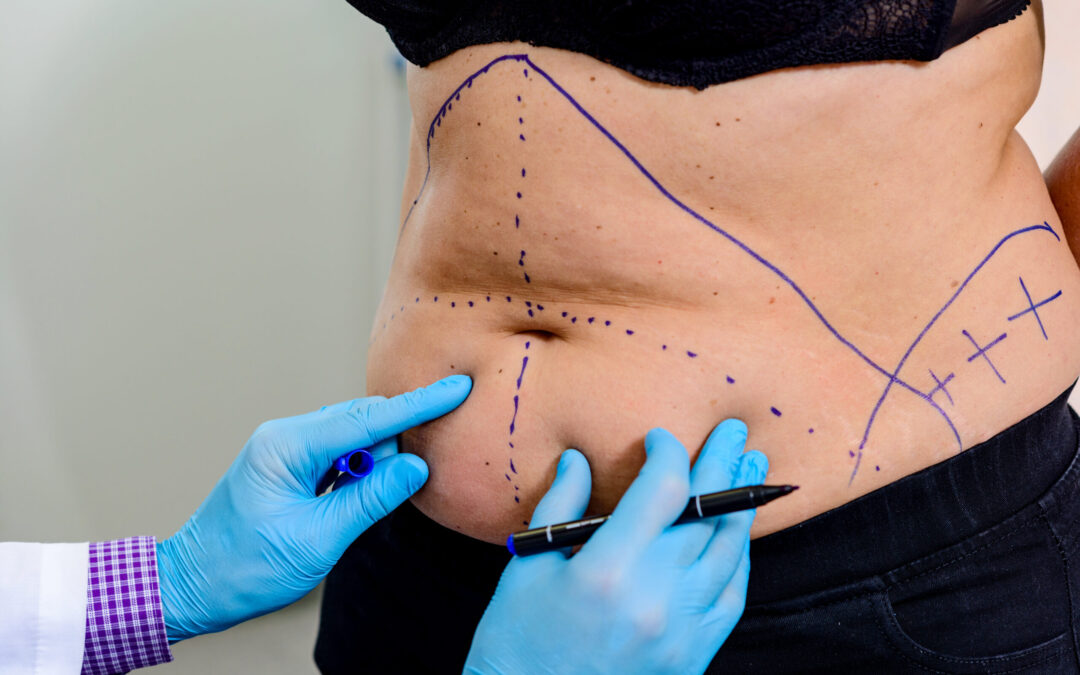 How Soon Can You Exercise After Liposuction Surgery?