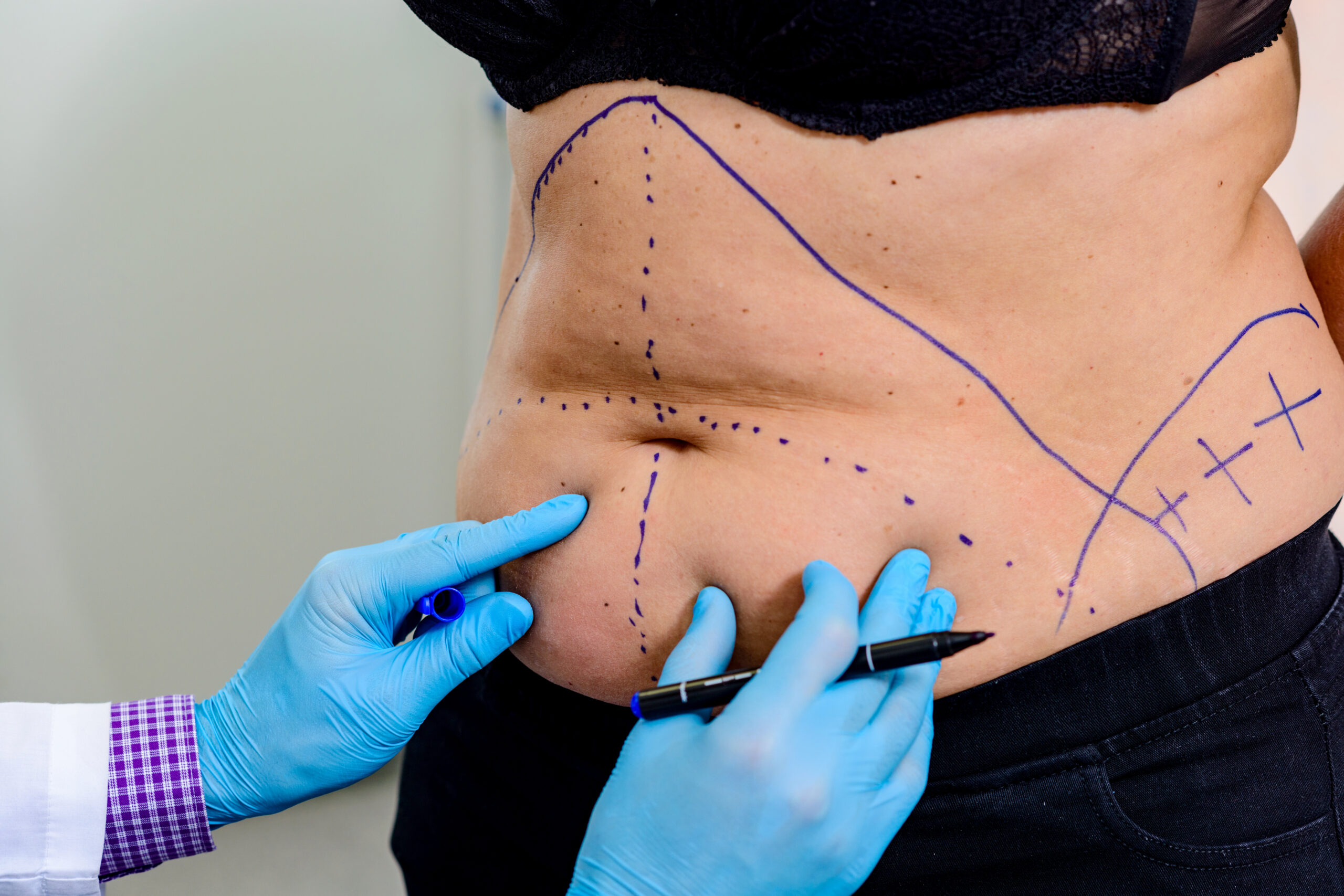 Define curves with liposuction