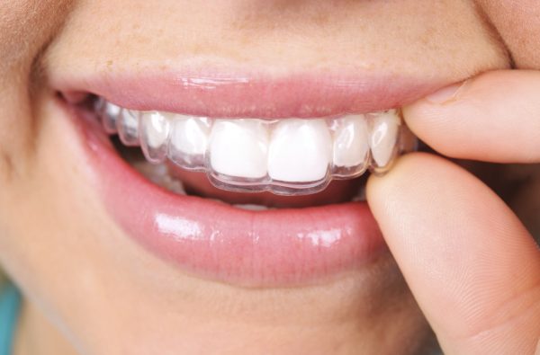 Dental Appliances Dubai