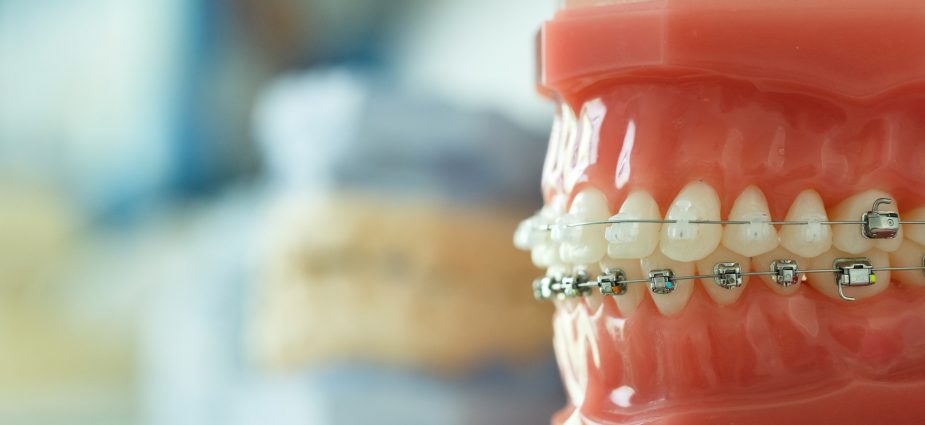Dental Braces in Dubai