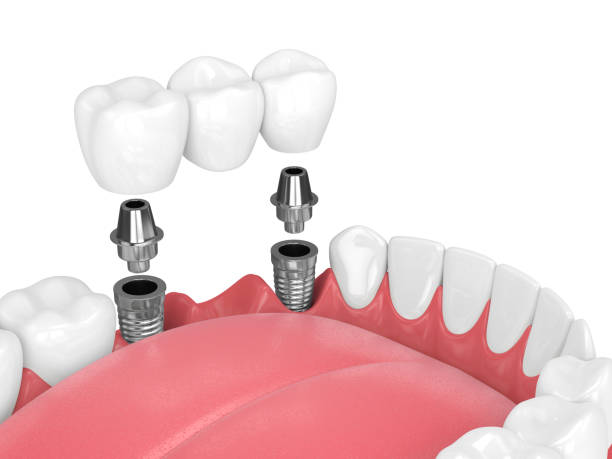 How Riyadh Residents Can Navigate Dental Implants Expenses