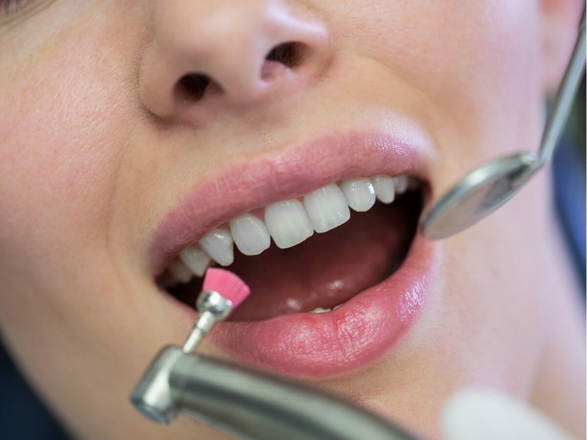 Dental scaling