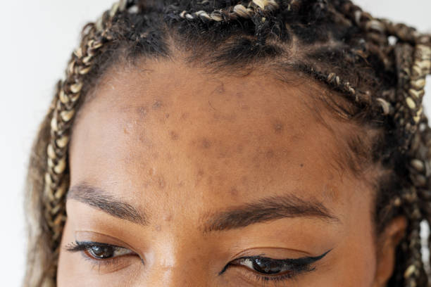 Does Acne Treatment Help with Dark Spots?