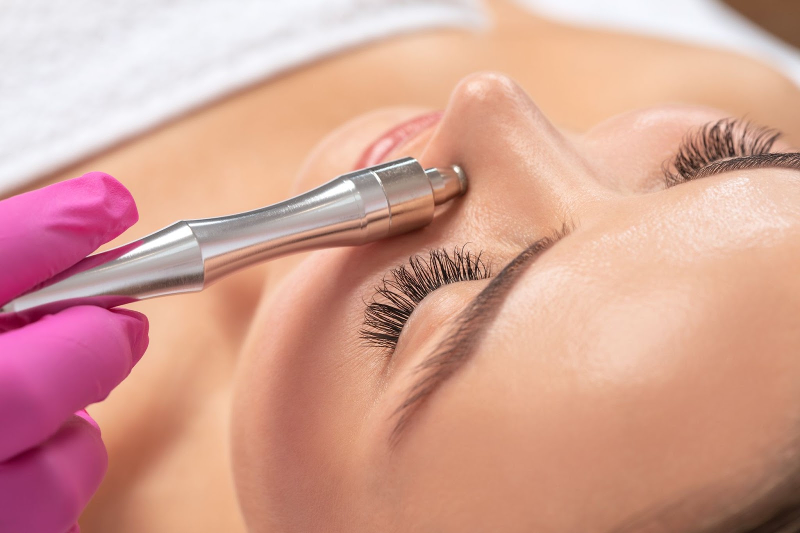 Does Microdermabrasion Treatment Remove Blackheads