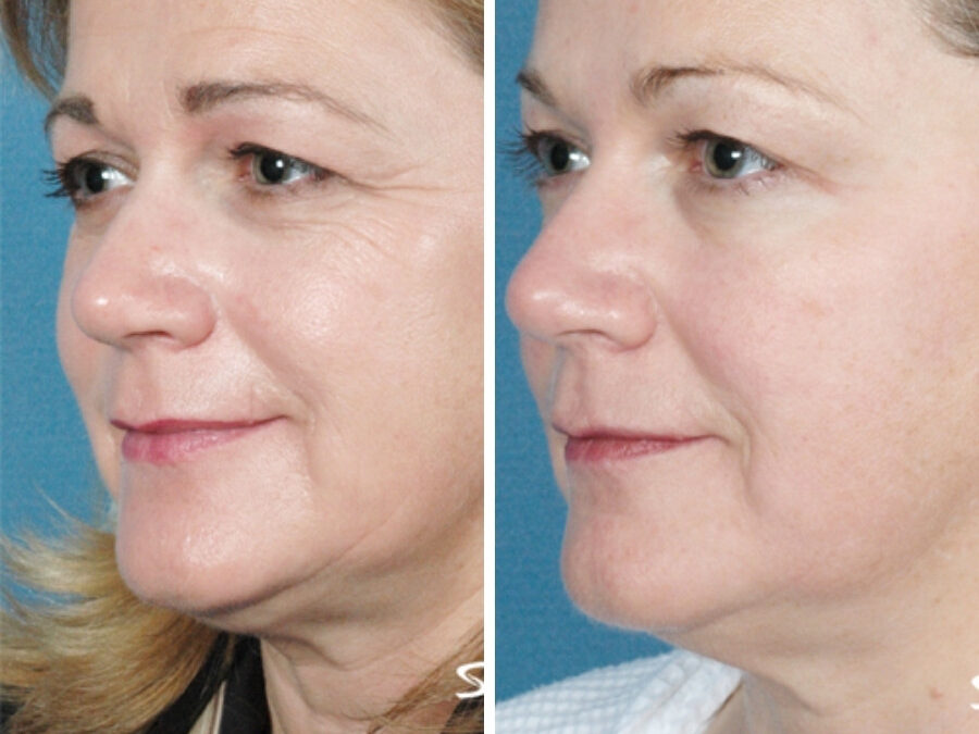 Does Laser Skin Tightening Help with Sagging Jowls?