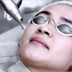 Fractional CO2 Laser Treatment in Dubai