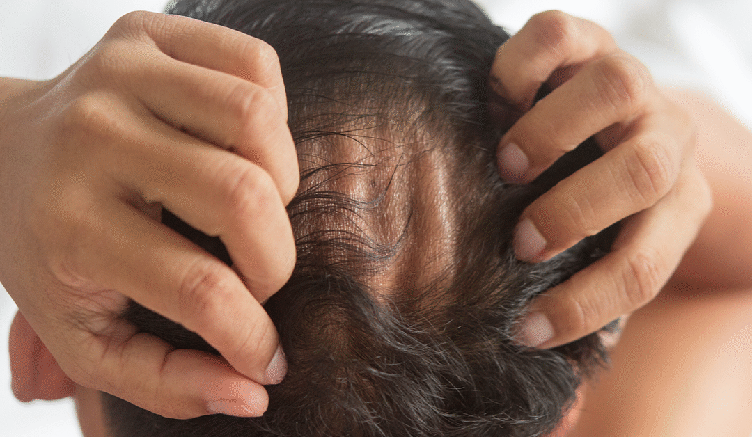 Does Hair Cloning Work for Genetic Hair Loss?