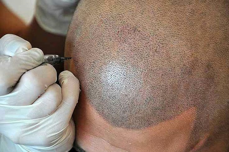 What to Expect from a Hair Transplant in Riyadh: Full Overview