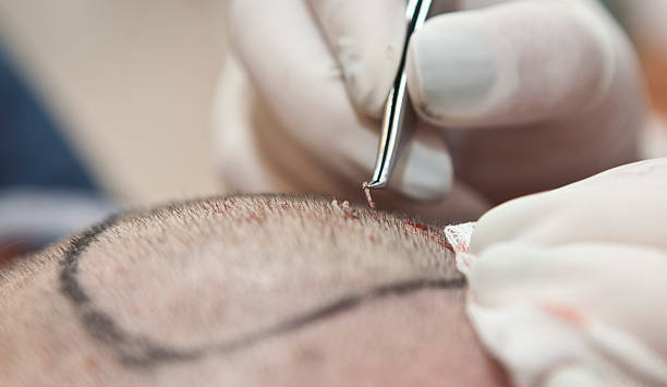 Hair Transplant in Dubai: FUE Method Advantages Explained