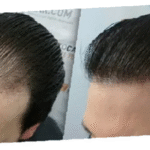 Hair Transplant in Dubai