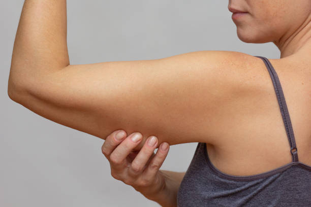 How Arm Lift Works to Tighten Droopy Skin ?