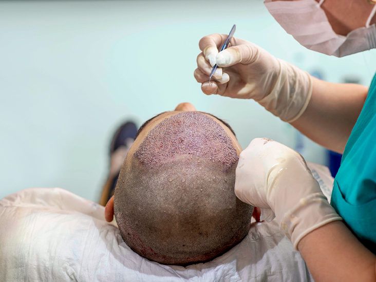 How FUE Hair Transplant Cost Can Affect Your Results