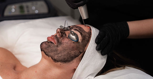 How Laser Carbon Peel Works to Exfoliate Dead Skin?