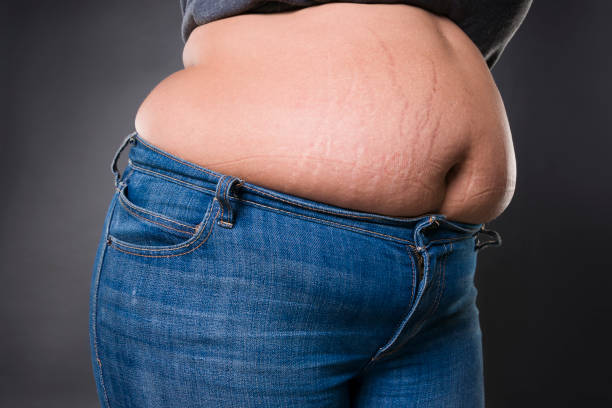 How Mini Abdominoplasty Helps Flatten the Lower Abdomen?