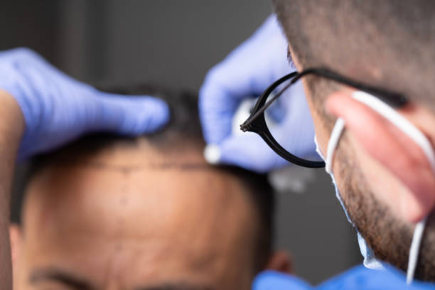 How Soon Can You See Results from a Hair Transplant?