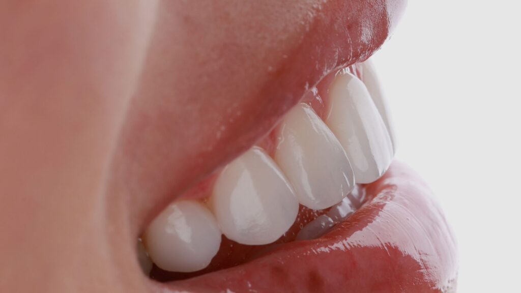 How to Maintain a Natural Look with Composite Veneers
