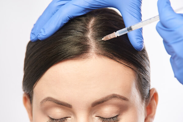 Is PRP Hair Therapy Effective for Early Baldness