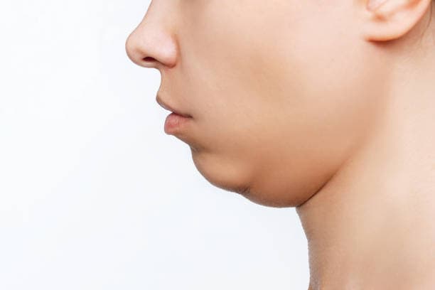 Laser and Injection Solutions for Double Chin