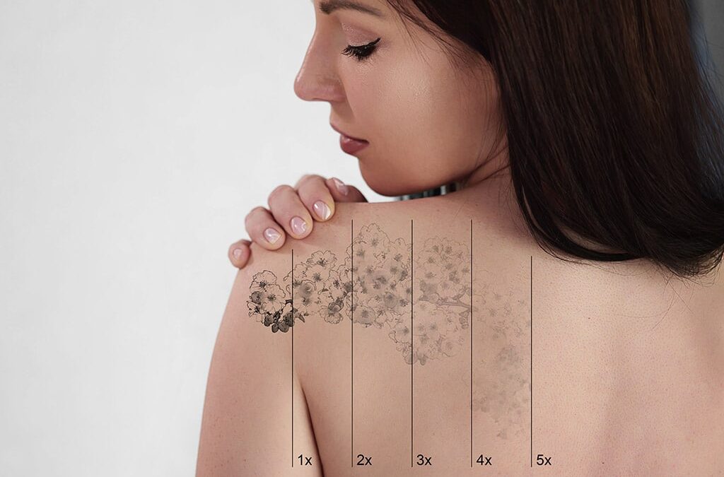 How Do I Know If I’m a Good Candidate for Laser Tattoo Removal?