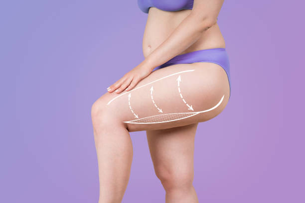 Why Liposuction in Riyadh Is a Preferred Choice for Fat Removal