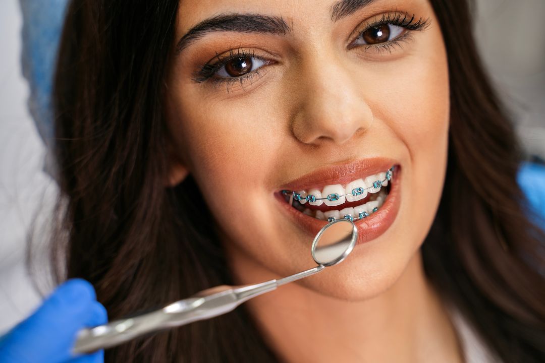 Metal braces treatment time
