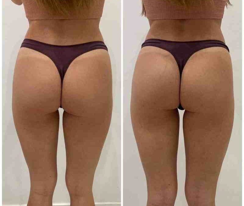 Can You Combine a Non Surgical Bum Lift with Other Treatments?