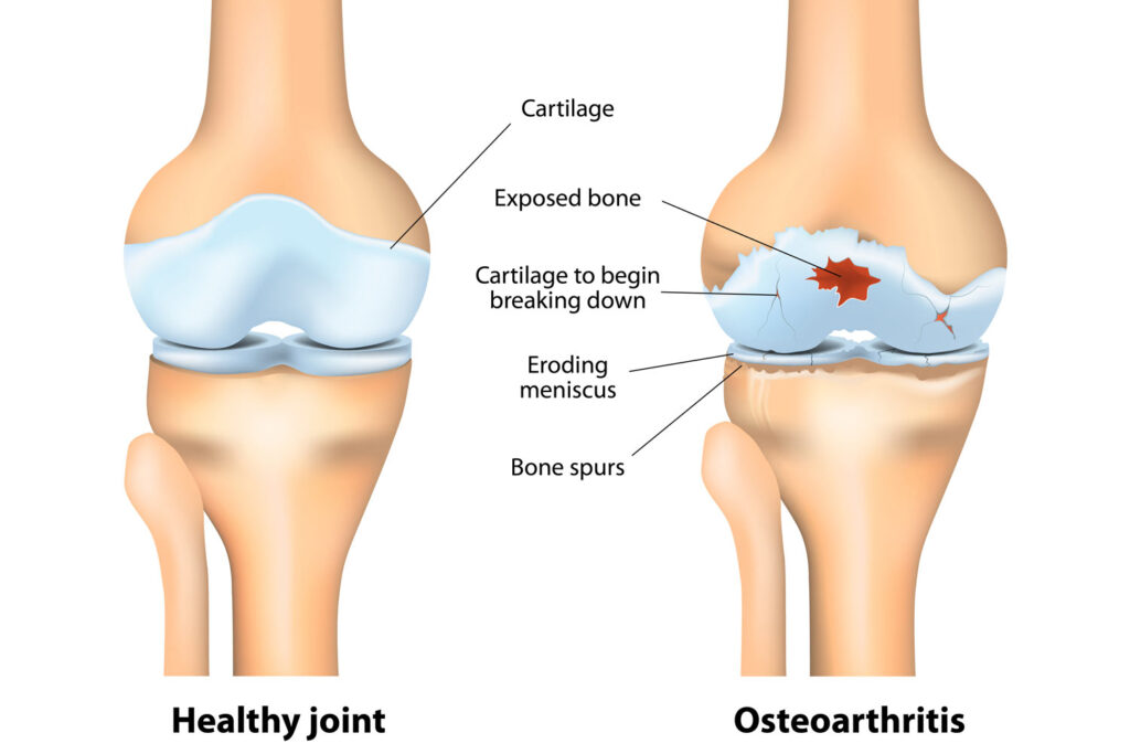 Osteoarthritis-icd-10-1-1024x683