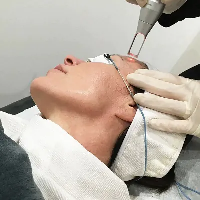 Pico Laser Quick and Effective Skin Treatments1