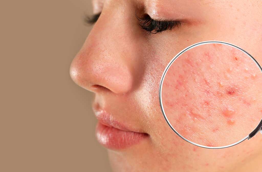 Pimples Treatment in Dubai: How To Prevent New Pimples