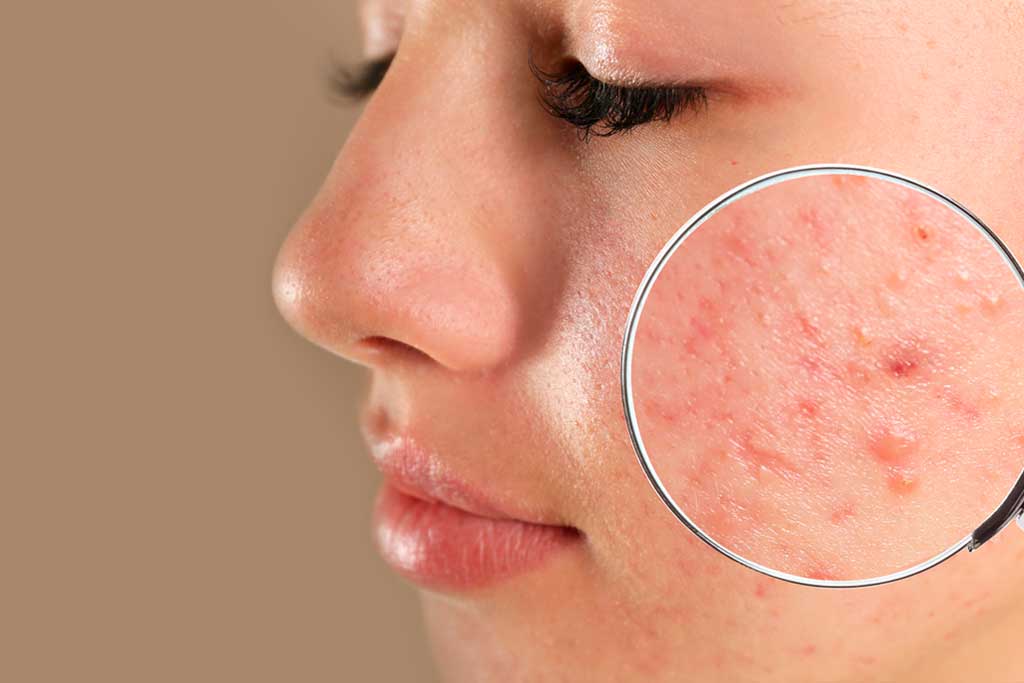 Pimples Treatment in Dubai
