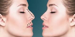 Key Factors When Choosing a Rhinoplasty Surgeon in Riyadh