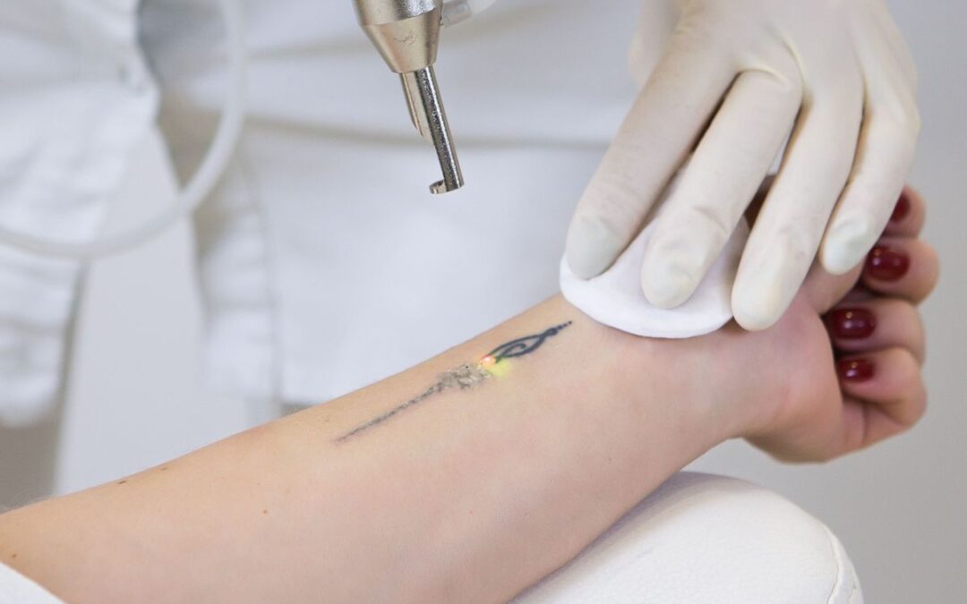 Say Goodbye to Unwanted Ink with Safe and Effective Tattoo Removal in Dubai