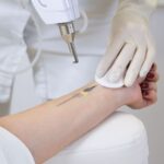 Tattoo Removal in Dubai