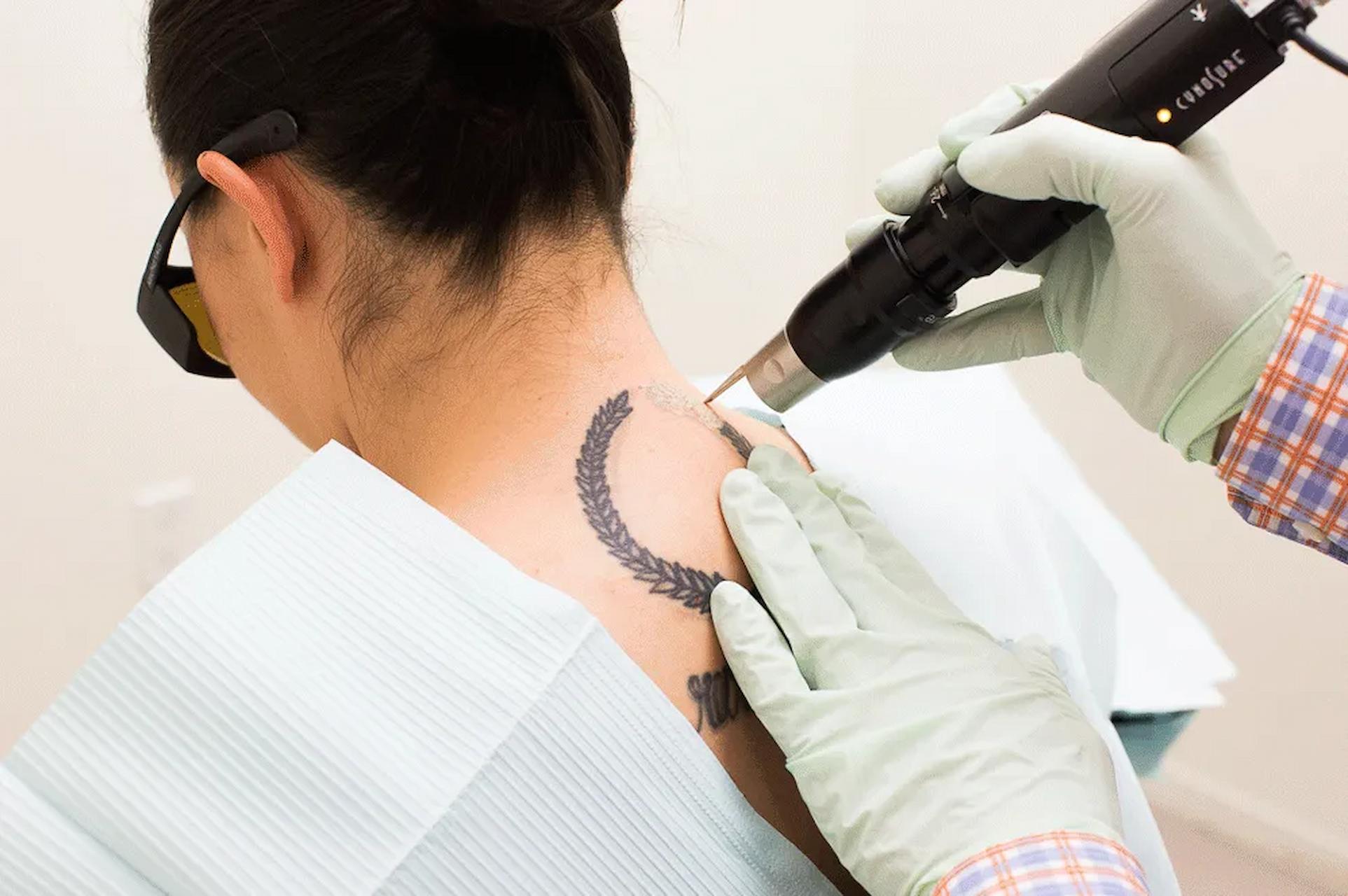 Tattoo Removal in Dubai