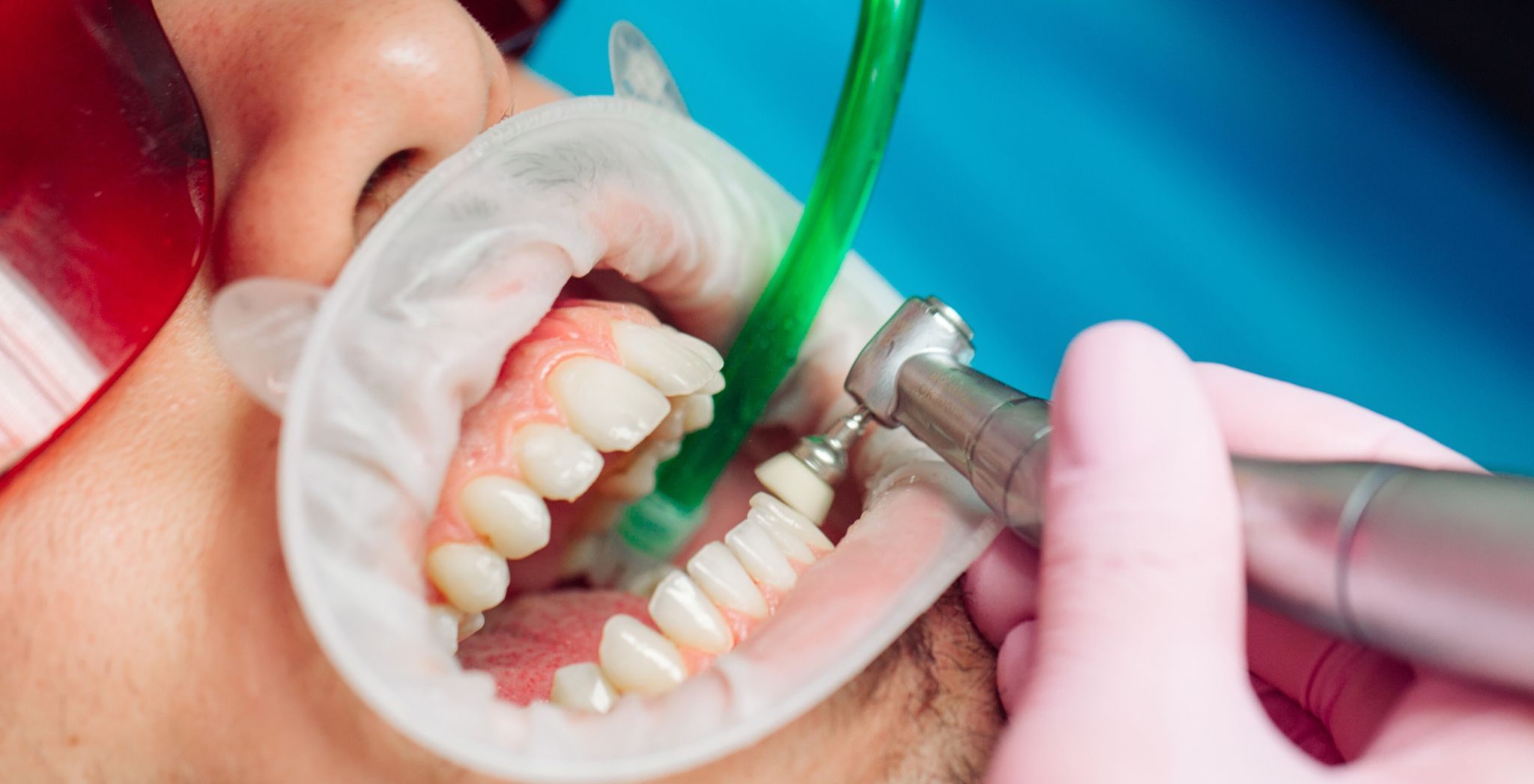Teeth Cleaning During Pregnancy What Moms-to-Be Should Know