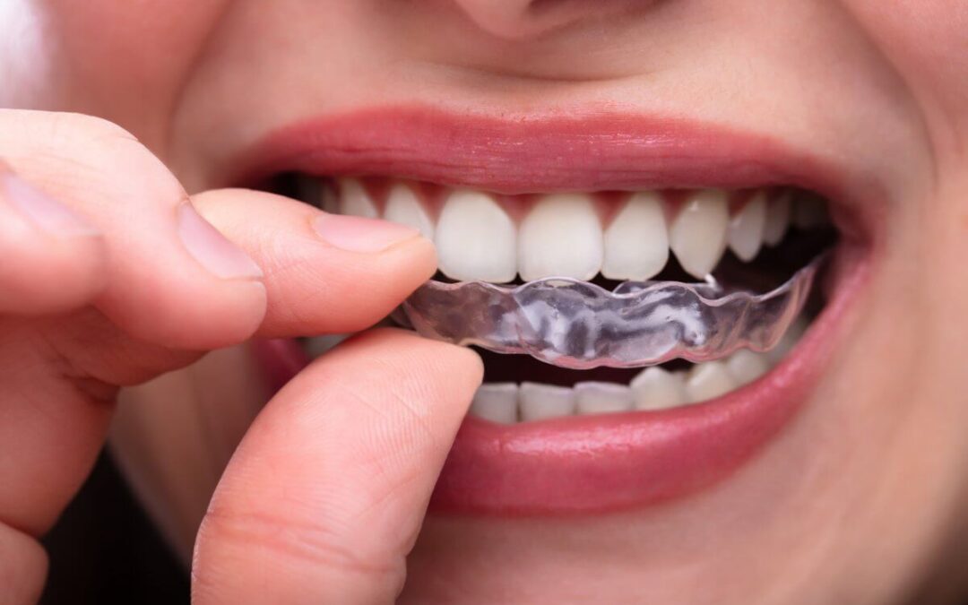 Teeth Grinding Treatment: Comparing Home Remedies vs. Professional Help