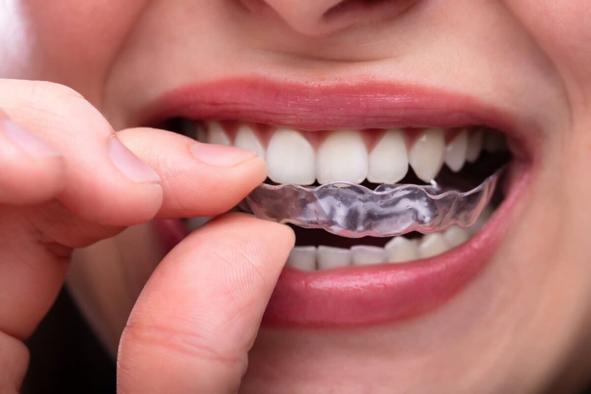 Teeth Grinding Treatment Comparing Home Remedies vs. Professional Help
