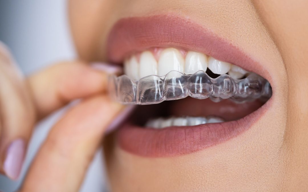 Aligners and Orthodontic Emergencies: What to Do