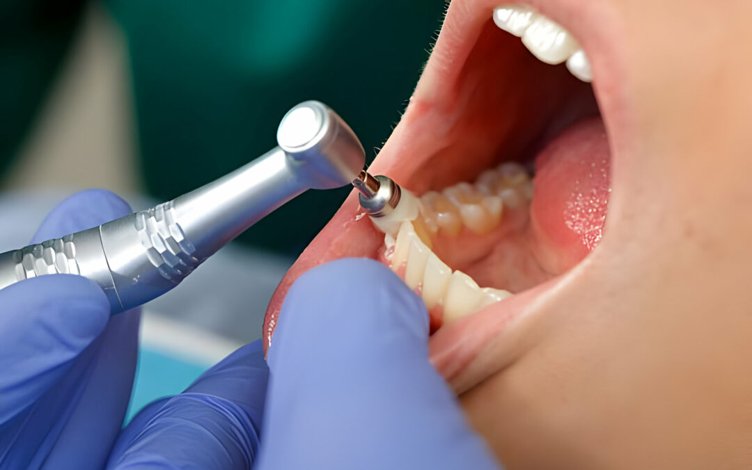 Teeth Cleaning Tips for People with Sensitive Teeth