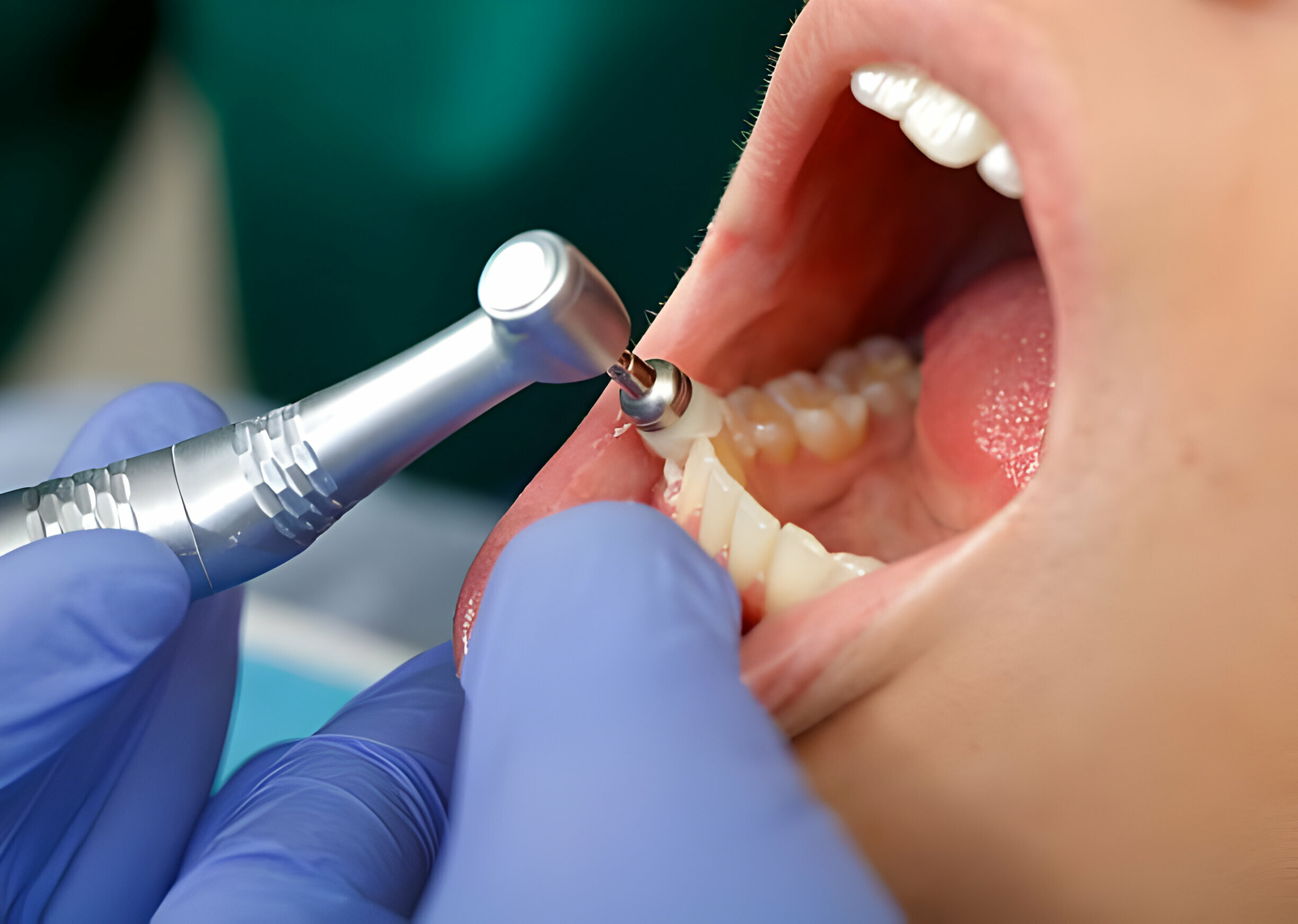 Teeth cleaning price