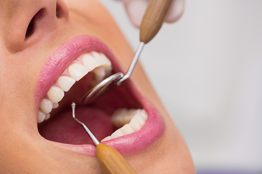 How Long Do Dental Fillings Last?