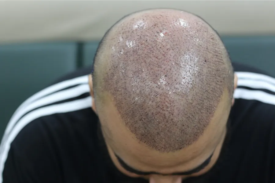 Transform Thinning Hair with FUT Transplant